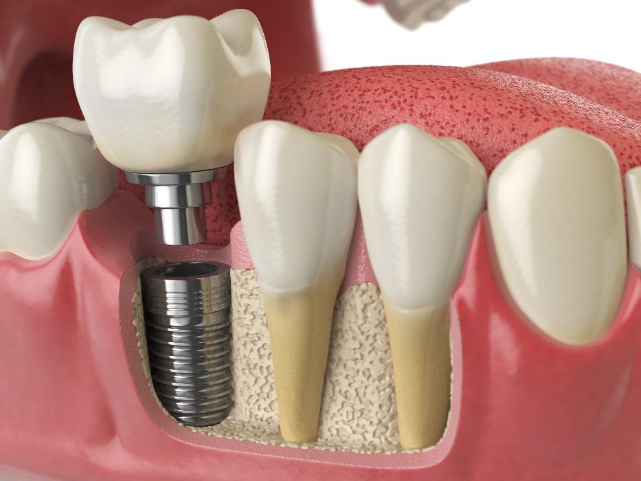 close up of dental implant in jaw | dental implants in dumbo