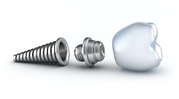 An illustration of a dental implant and dental implant screw