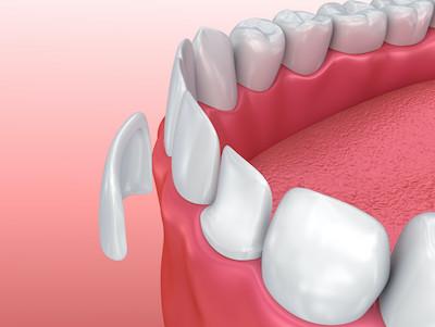 3D rendering of dental veneer on tooth | dental veneers brooklyn