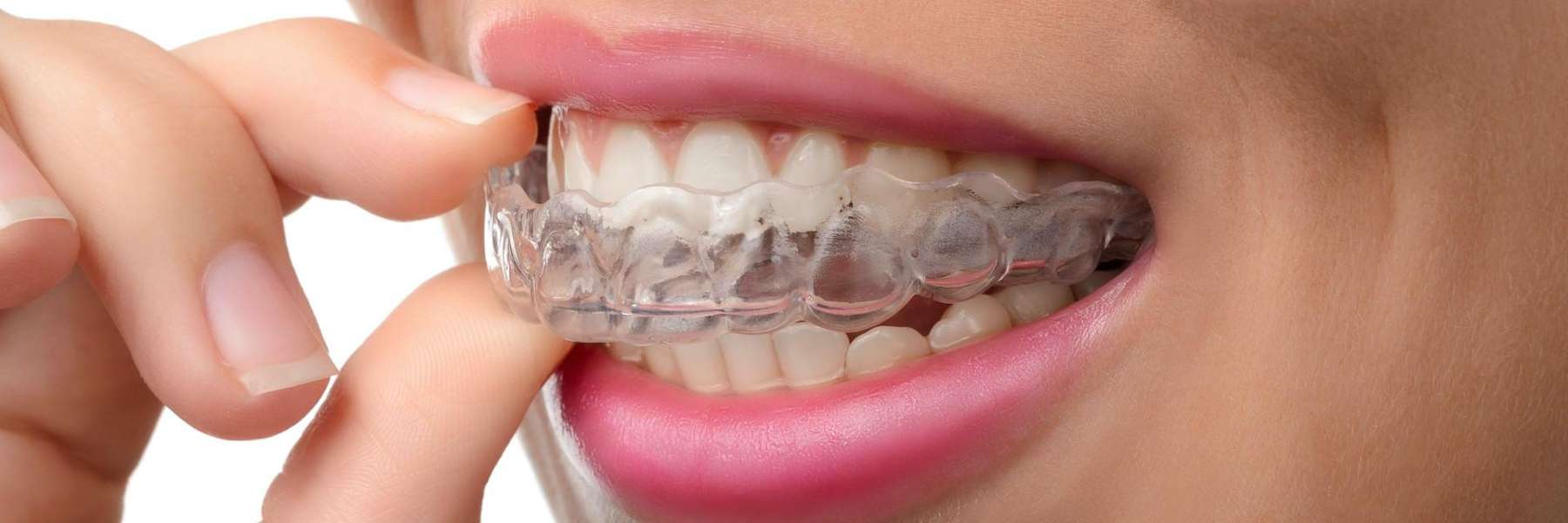 patient putting in clear aligner | invisalign dumbo ny